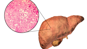 5 Tell-Tale Signs Your Fatty Liver Is Recovering: How to Spot the Healing Process