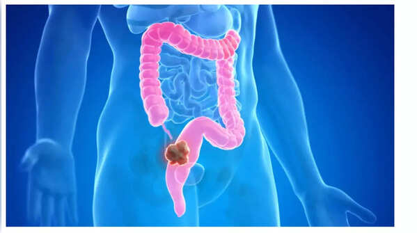 Depiction of unexplained weight loss, a potential sign of colon cancer