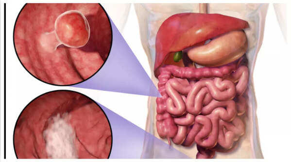 Depiction of blood in stool as a potential colon cancer sign